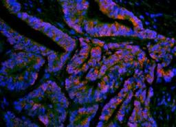 Immunohistochemical analysis of formalin-fixed and paraffin-embedded human rectal carcinoma tissue anti-ompF (primary antibody dilution at 1:200)