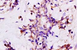 Paraffin-embedded human breast carcinoma tissue fixed with 4% paraformaldehyde. Antigen retrieval by boiling with citrate buffer. Blocking buffer is goat serum (37 degrees for 20 min.). GREB1 antibody at 1:200 dilution with overnight incubation at 4 degre