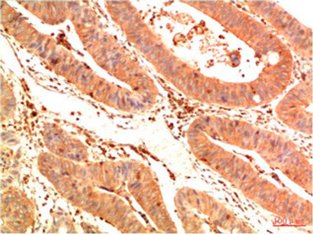 Immunohistochemical analysis of paraffin-embedded Human Colon Carcinoma Tissue using Acetyl P53(K382) Mouse mAb diluted at 1:200.