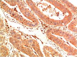 Immunohistochemical analysis of paraffin-embedded Human Colon Carcinoma Tissue using Acetyl P53(K382) Mouse mAb diluted at 1:200.