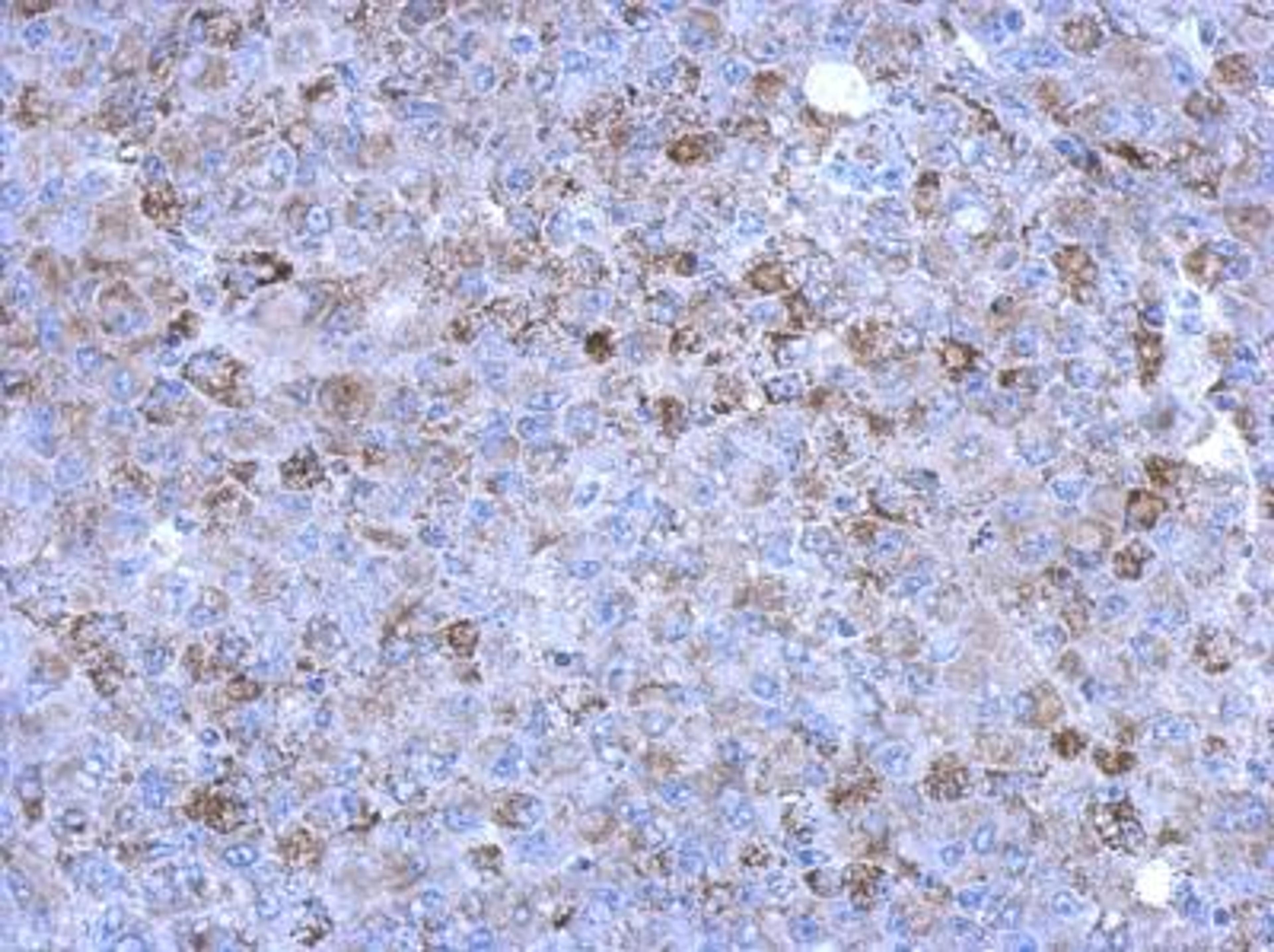 Immunohistochemistry-Paraffin: SLC25A15 Antibody [NBP2-20387] - Hela xenograft, using antibody at 1:500 dilution.