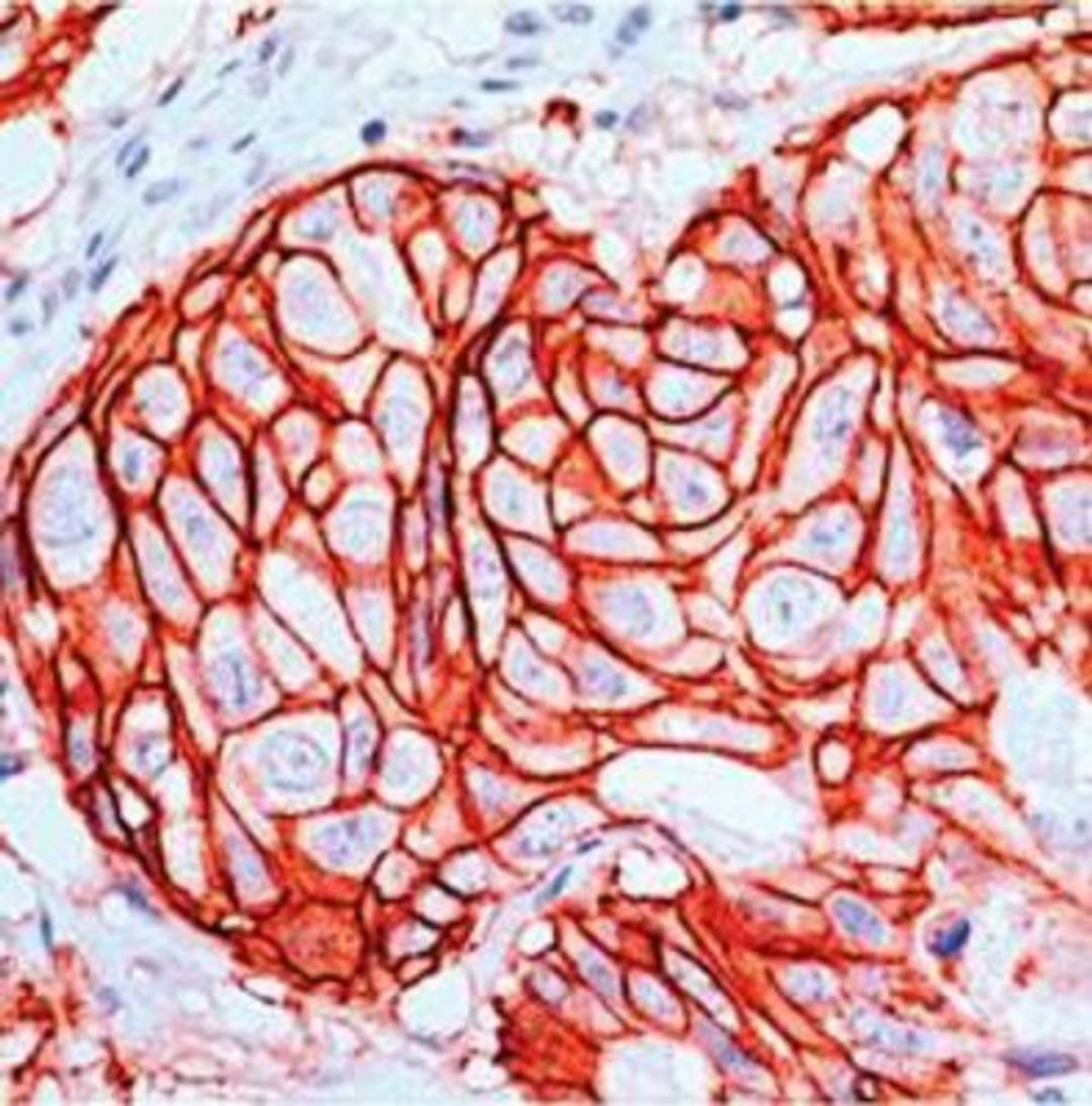 Immunohistochemistry-Paraffin: ErbB2/HER2 Antibody (SP3) [NBP1-49793] - c-erbB-2/HER-2