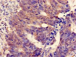 Immunohistochemistry of paraffin-embedded human colon cancer using CSB-PA013792LA01HU at dilution of 1:100