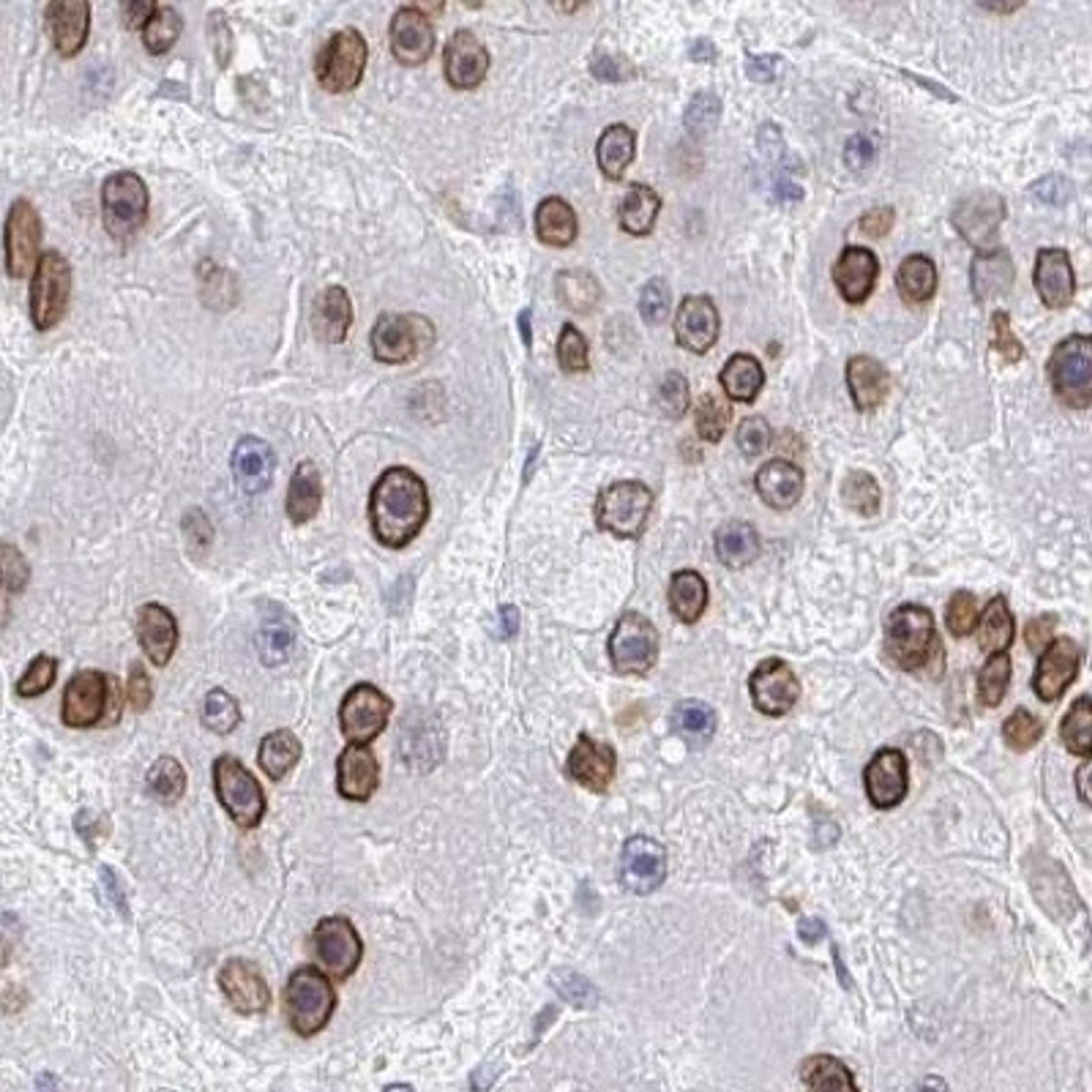 Immunohistochemistry: CHD2 Antibody [NBP2-32563] - liver cancer