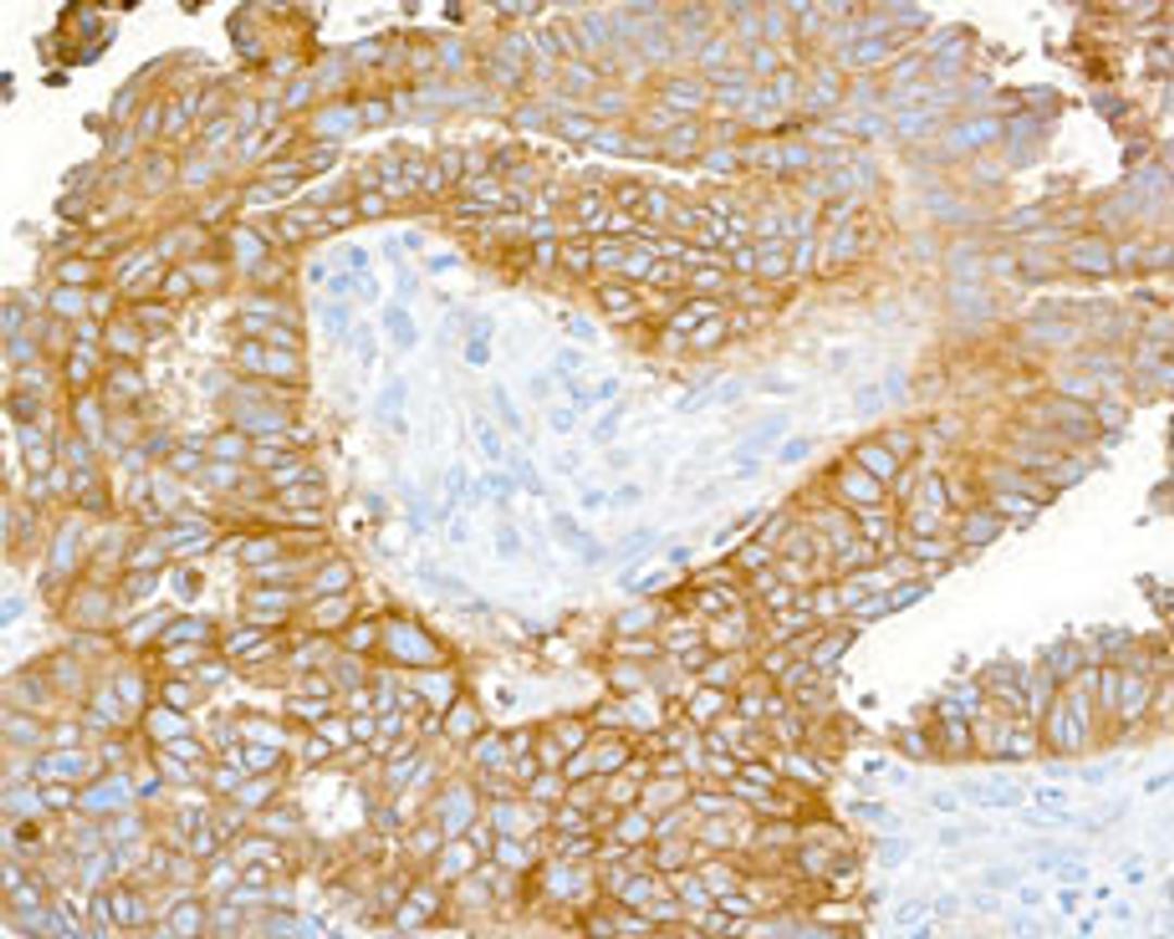 Detection of human CD47 in FFPE ovarian carcinoma by immunohistochemistry.