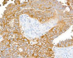 Detection of human CD47 in FFPE ovarian carcinoma by immunohistochemistry.