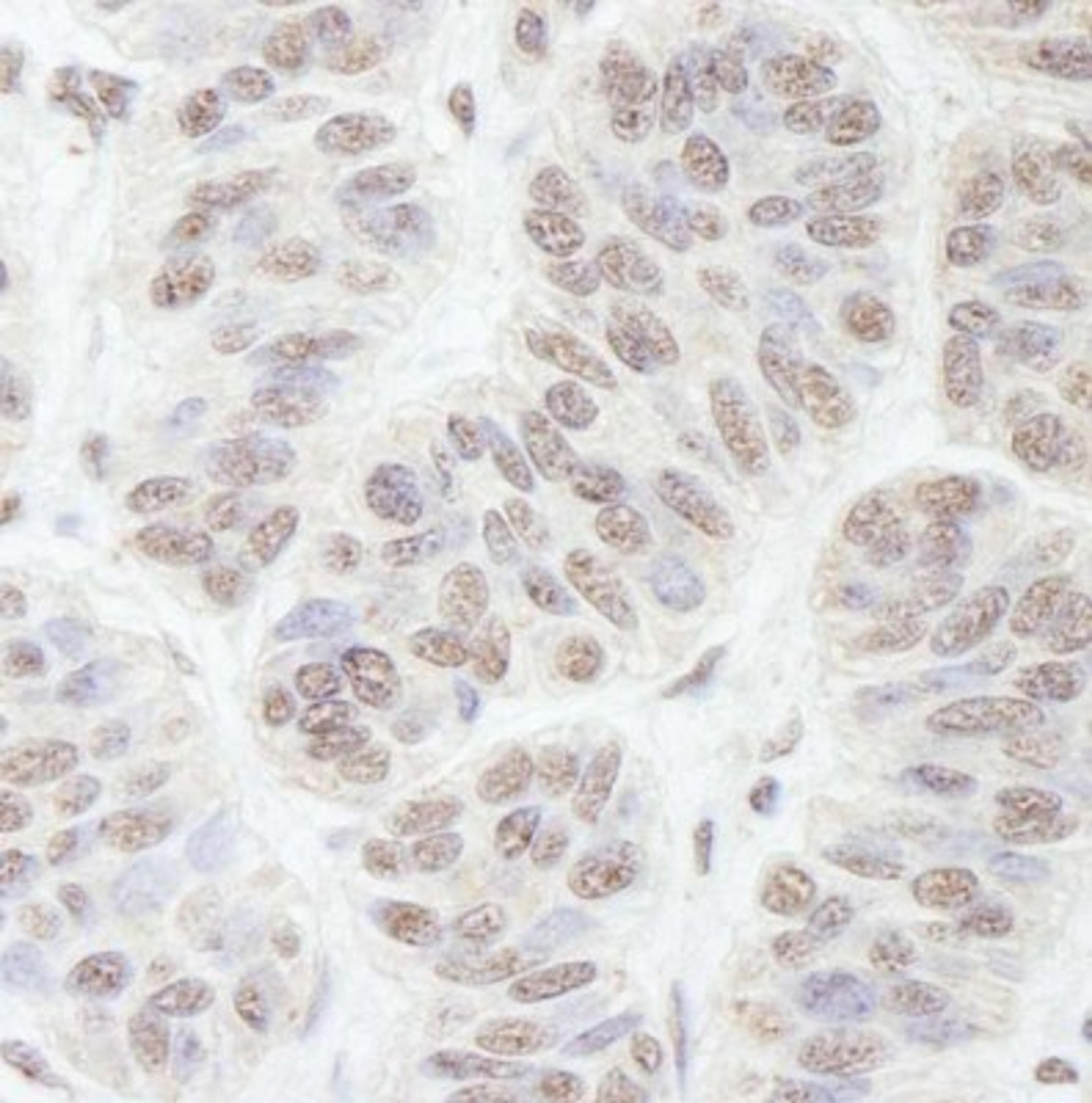 Immunohistochemistry-Paraffin: Nucleostemin Antibody [NB100-1568] - Human skin carcinoma.  Antibody used at a dilution of 1:200.