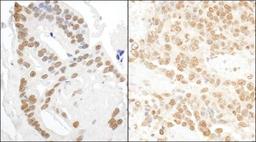 Immunohistochemistry-Paraffin: DDX27 Antibody [NBP1-26601] - Human prostate carcinoma (left) and mouse teratoma (right).  Antibody used at a dilution of 1:5,000 (0.2ug/ml) and 1:1,000 (1ug/ml).