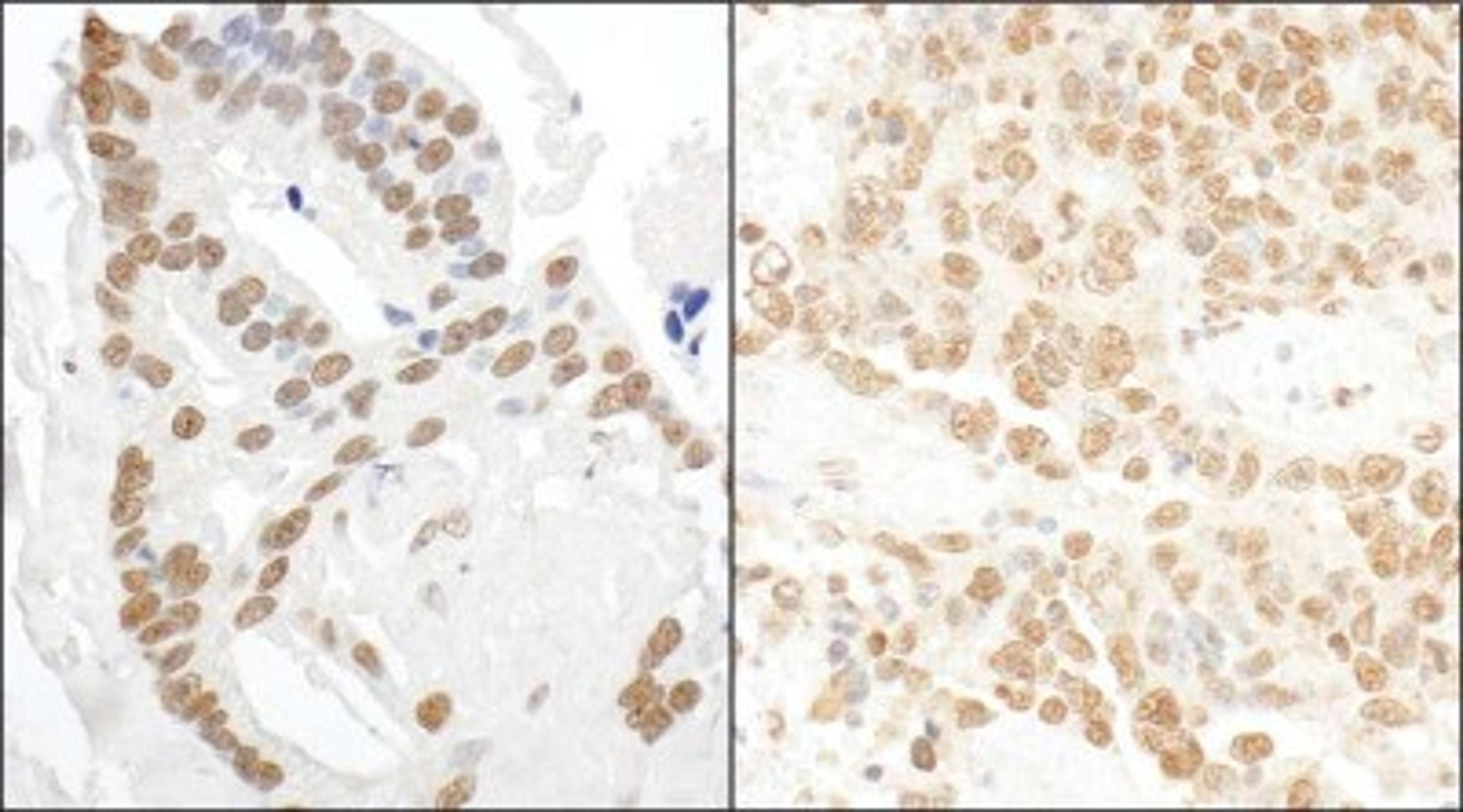 Immunohistochemistry-Paraffin: DDX27 Antibody [NBP1-26601] - Human prostate carcinoma (left) and mouse teratoma (right).  Antibody used at a dilution of 1:5,000 (0.2ug/ml) and 1:1,000 (1ug/ml).