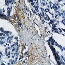 Immunohistochemical analysis of formalin-fixed and paraffin embedded human breast cancer tissue using MT-ND6 antibody