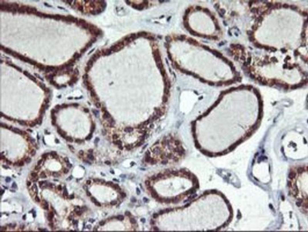 Immunohistochemistry-Paraffin: ALG2 Antibody (3C2) [NBP2-01734] - Staining of paraffin-embedded Carcinoma of Human thyroid tissue using anti-ALG2 mouse monoclonal antibody.