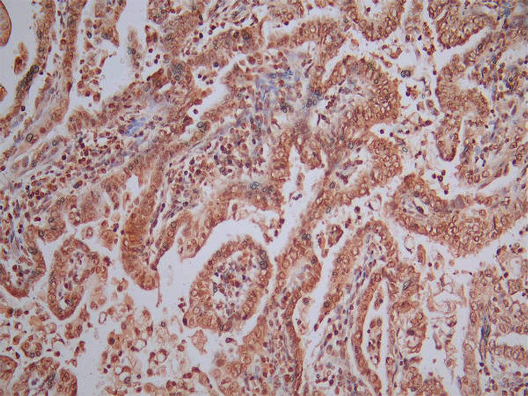IHC image of CSB-RA001492MA1HU diluted at 1:50 and staining in paraffin-embedded human endometrial cancer performed on a Leica BondTM system. After dewaxing and hydration, antigen retrieval was mediated by high pressure in a citrate buffer (pH 6.0). Section was blocked with 10% normal goat serum 30min at RT. Then primary antibody (1% BSA) was incubated at 4°C overnight. The primary is detected by a Goat anti-Mouse IgG labeled by HRP and visualized using 0.05% DAB.