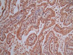 IHC image of CSB-RA001492MA1HU diluted at 1:50 and staining in paraffin-embedded human endometrial cancer performed on a Leica BondTM system. After dewaxing and hydration, antigen retrieval was mediated by high pressure in a citrate buffer (pH 6.0). Section was blocked with 10% normal goat serum 30min at RT. Then primary antibody (1% BSA) was incubated at 4°C overnight. The primary is detected by a Goat anti-Mouse IgG labeled by HRP and visualized using 0.05% DAB.