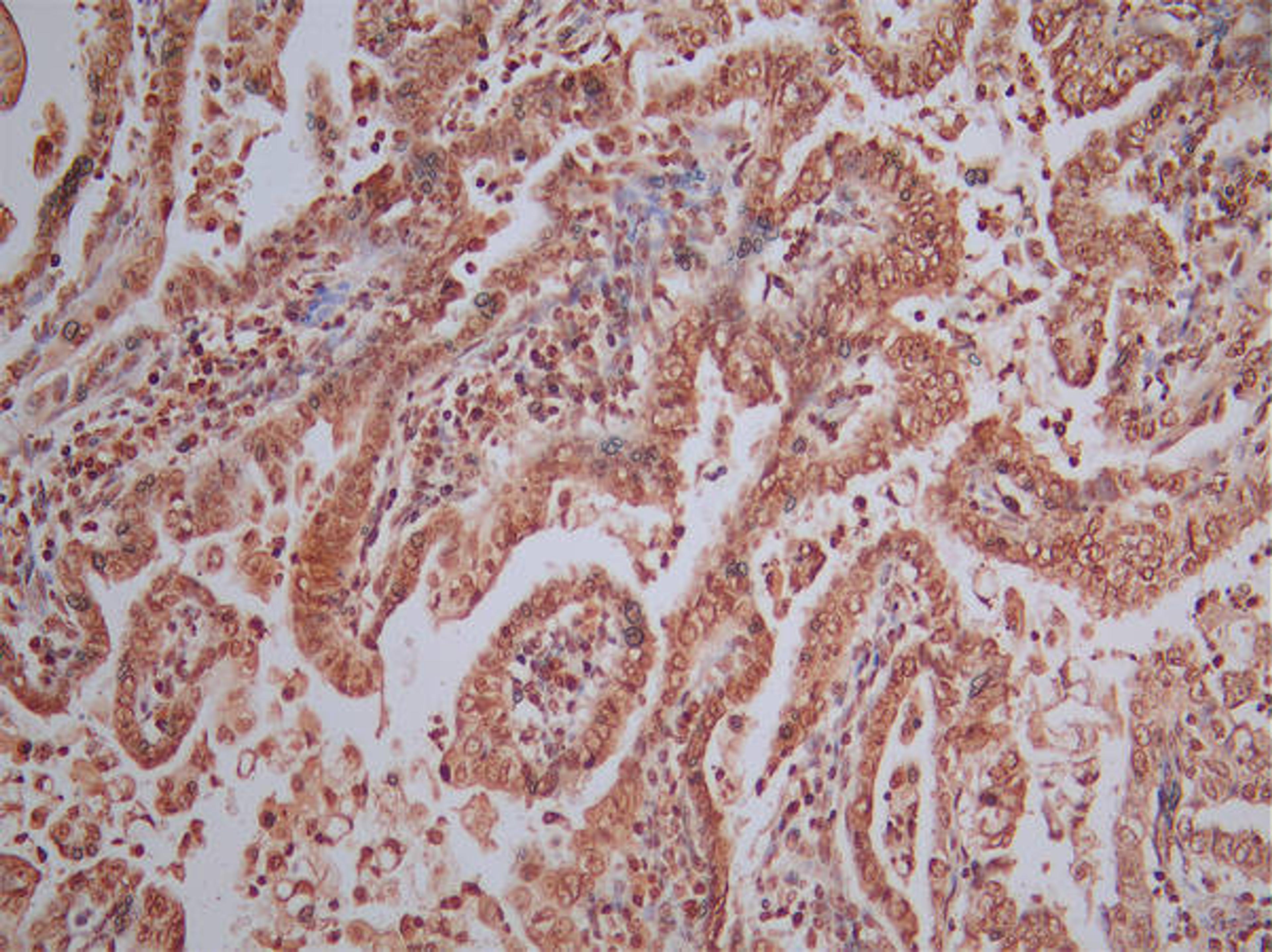 IHC image of CSB-RA001492MA1HU diluted at 1:50 and staining in paraffin-embedded human endometrial cancer performed on a Leica BondTM system. After dewaxing and hydration, antigen retrieval was mediated by high pressure in a citrate buffer (pH 6.0). Section was blocked with 10% normal goat serum 30min at RT. Then primary antibody (1% BSA) was incubated at 4°C overnight. The primary is detected by a Goat anti-Mouse IgG labeled by HRP and visualized using 0.05% DAB.