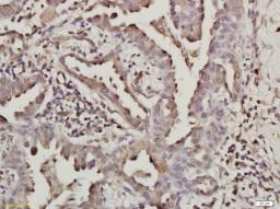 IHC-P from different cancer patients(Adenocarcinoma).