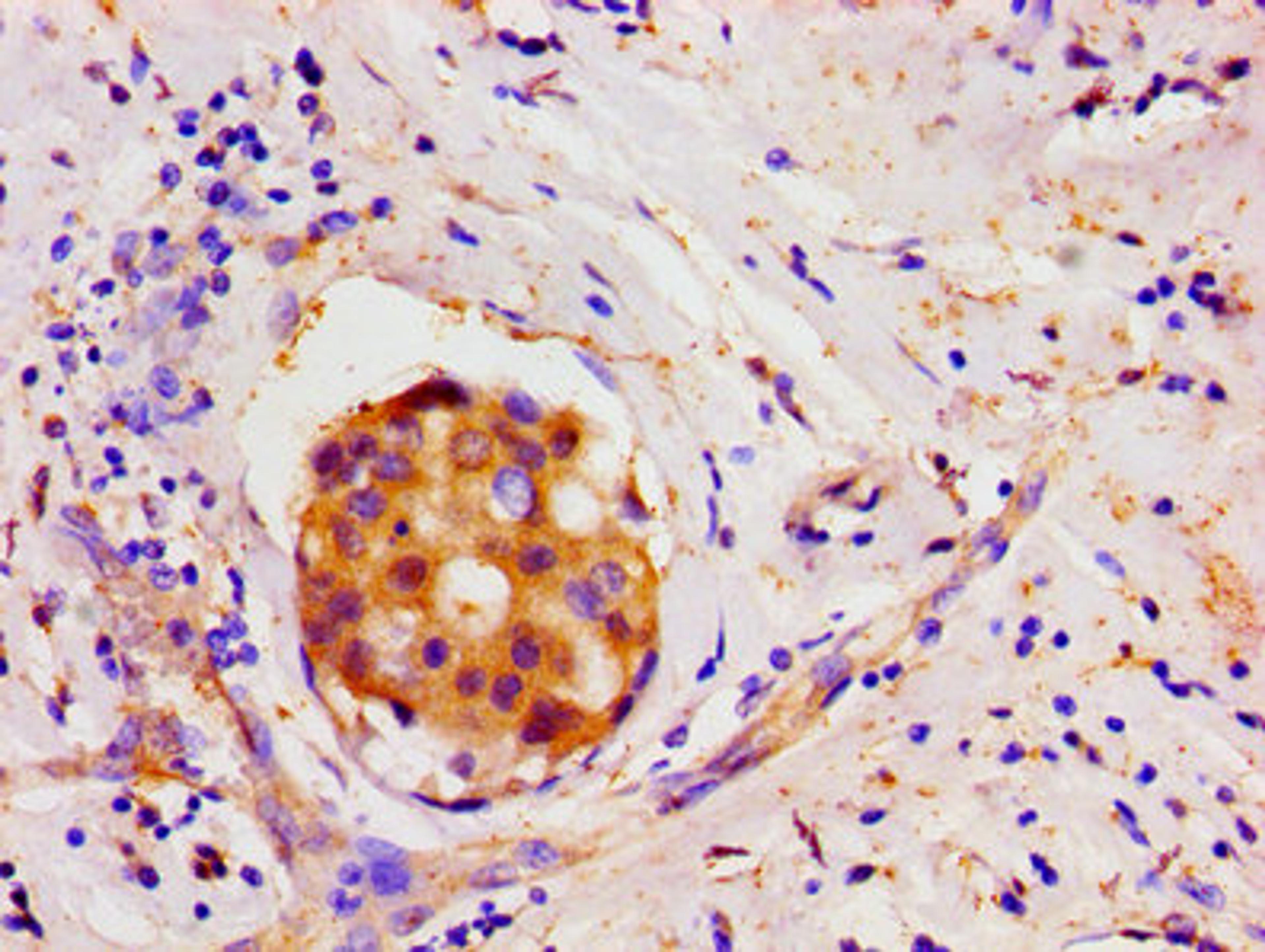 Immunohistochemistry of paraffin-embedded human breast cancer using CSB-PA13619A0Rb at dilution of 1:100