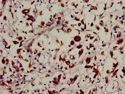 Immunohistochemistry of paraffin-embedded human melanoma using CSB-PA891982LA01HU at dilution of 1:100