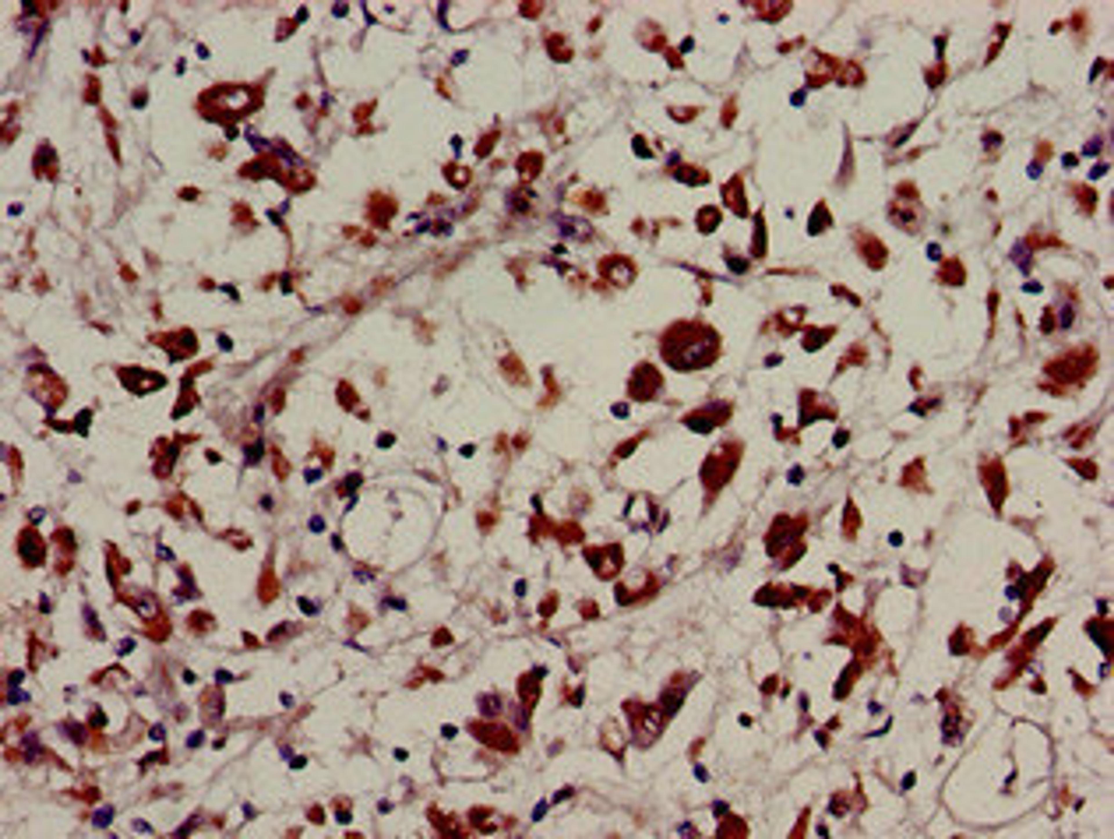 Immunohistochemistry of paraffin-embedded human melanoma using CSB-PA891982LA01HU at dilution of 1:100