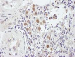 Detection of human MSH6 by immunohistochemistry.