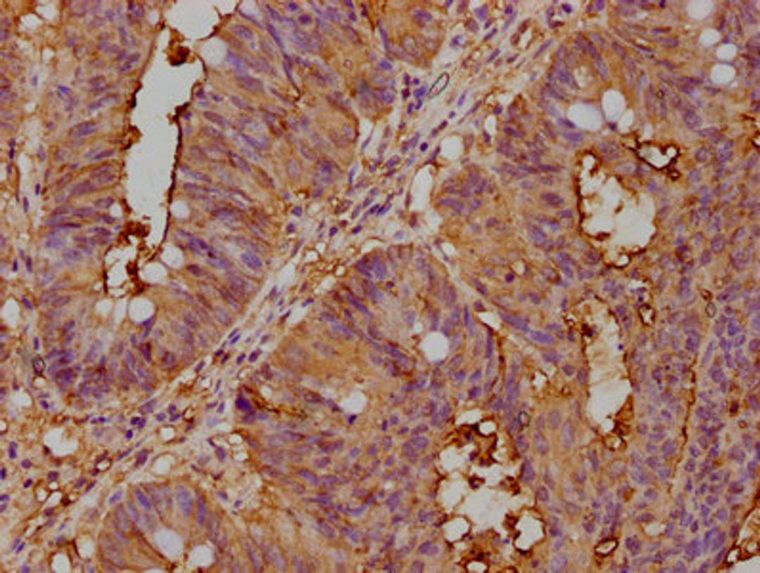 IHC image of CSB-PA005165LA01HU diluted at 1:400 and staining in paraffin-embedded human colon cancer performed on a Leica BondTM system. After dewaxing and hydration, antigen retrieval was mediated by high pressure in a citrate buffer (pH 6.0). Section was blocked with 10% normal goat serum 30min at RT. Then primary antibody (1% BSA) was incubated at 4°C overnight. The primary is detected by a biotinylated secondary antibody and visualized using an HRP conjugated SP system.