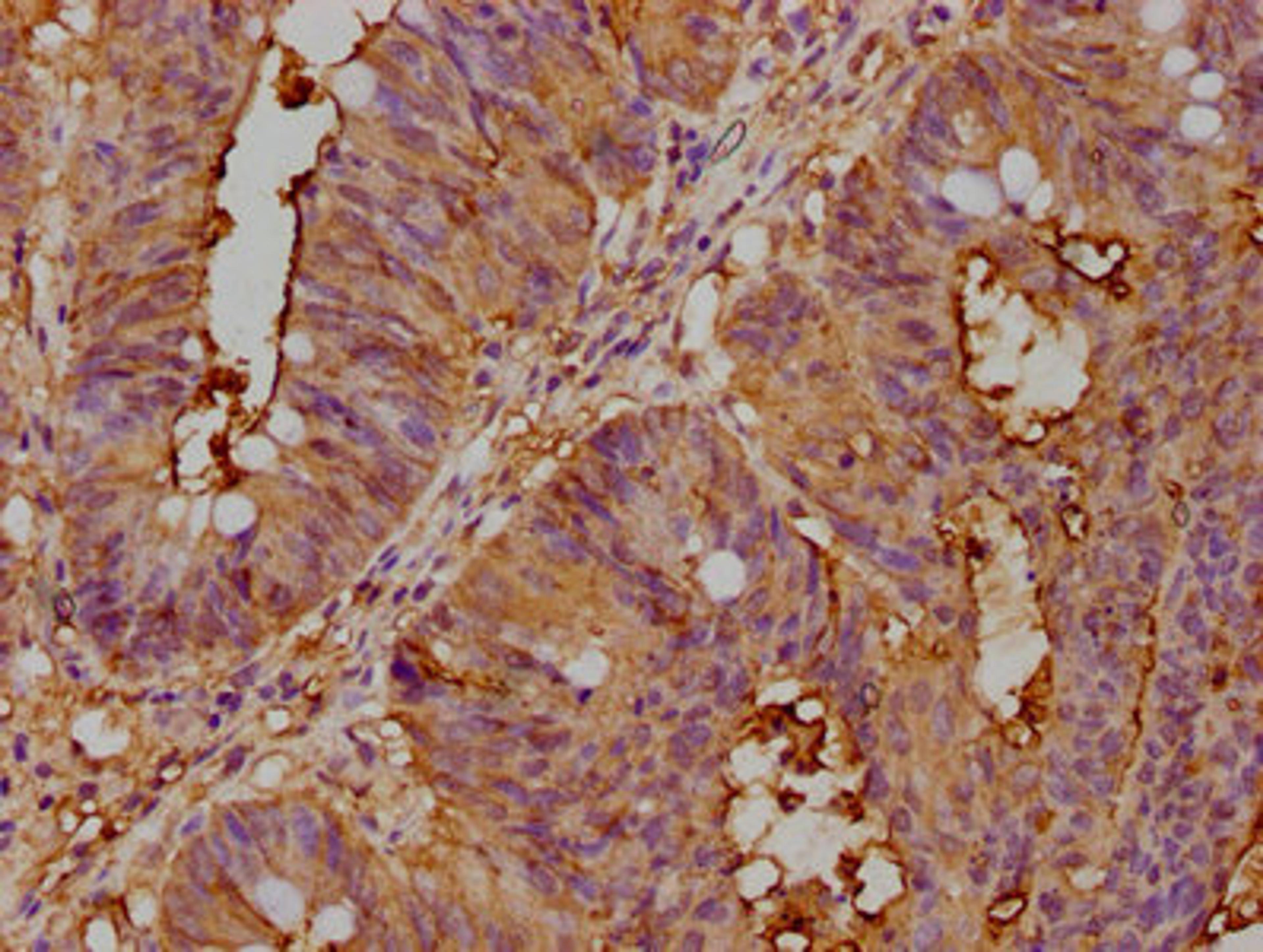 IHC image of CSB-PA005165LA01HU diluted at 1:400 and staining in paraffin-embedded human colon cancer performed on a Leica BondTM system. After dewaxing and hydration, antigen retrieval was mediated by high pressure in a citrate buffer (pH 6.0). Section was blocked with 10% normal goat serum 30min at RT. Then primary antibody (1% BSA) was incubated at 4°C overnight. The primary is detected by a biotinylated secondary antibody and visualized using an HRP conjugated SP system.