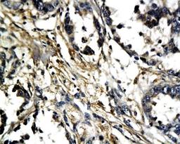 Immunohistochemical analysis of paraffin-embedded human breast cancer tissue using c-Fos antibody