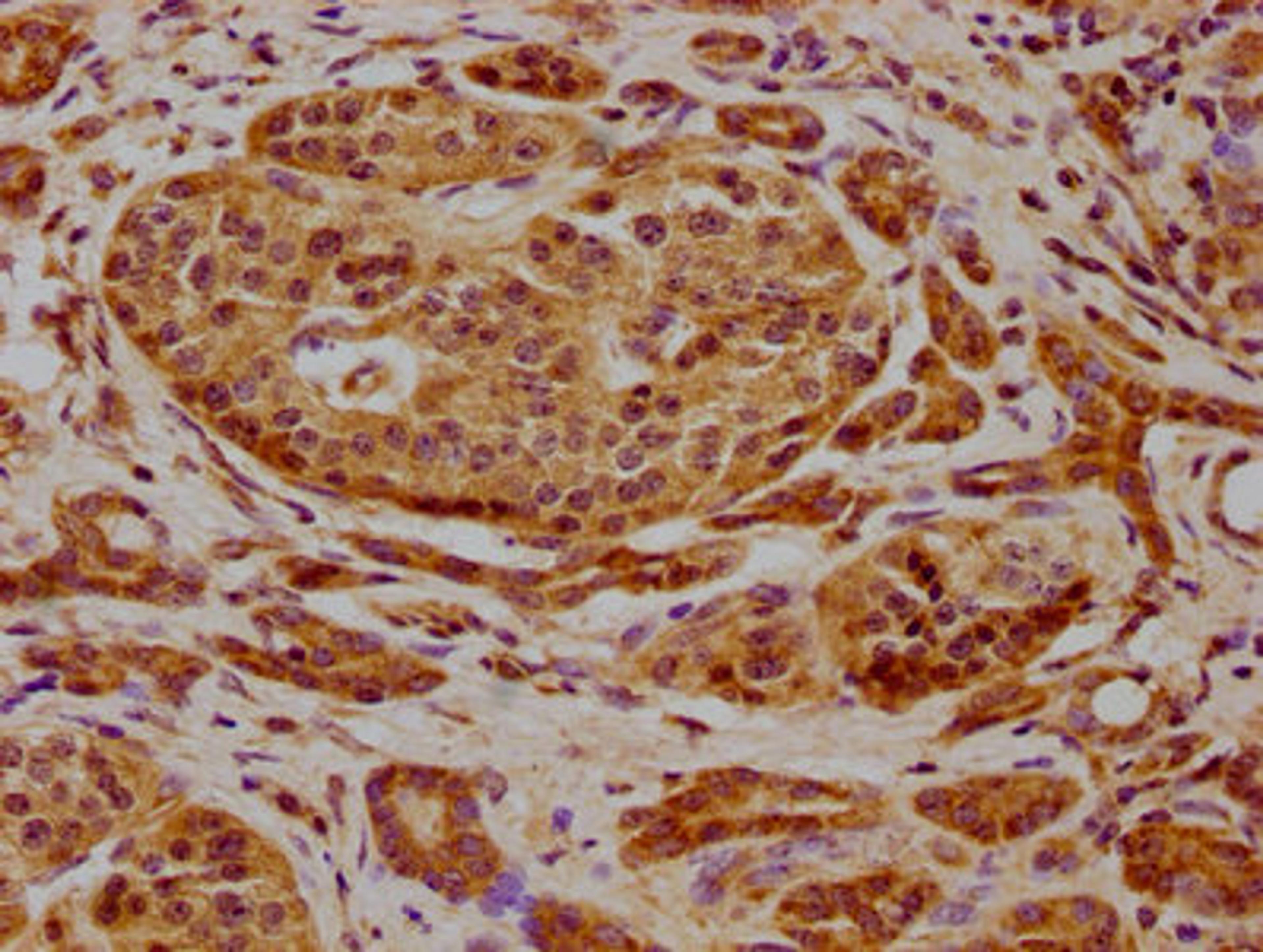 IHC image of CSB-PA009007LA01HU diluted at 1:600 and staining in paraffin-embedded human pancreatic cancer performed on a Leica BondTM system. After dewaxing and hydration, antigen retrieval was mediated by high pressure in a citrate buffer (pH 6.0). Section was blocked with 10% normal goat serum 30min at RT. Then primary antibody (1% BSA) was incubated at 4°C overnight. The primary is detected by a biotinylated secondary antibody and visualized using an HRP conjugated SP system.