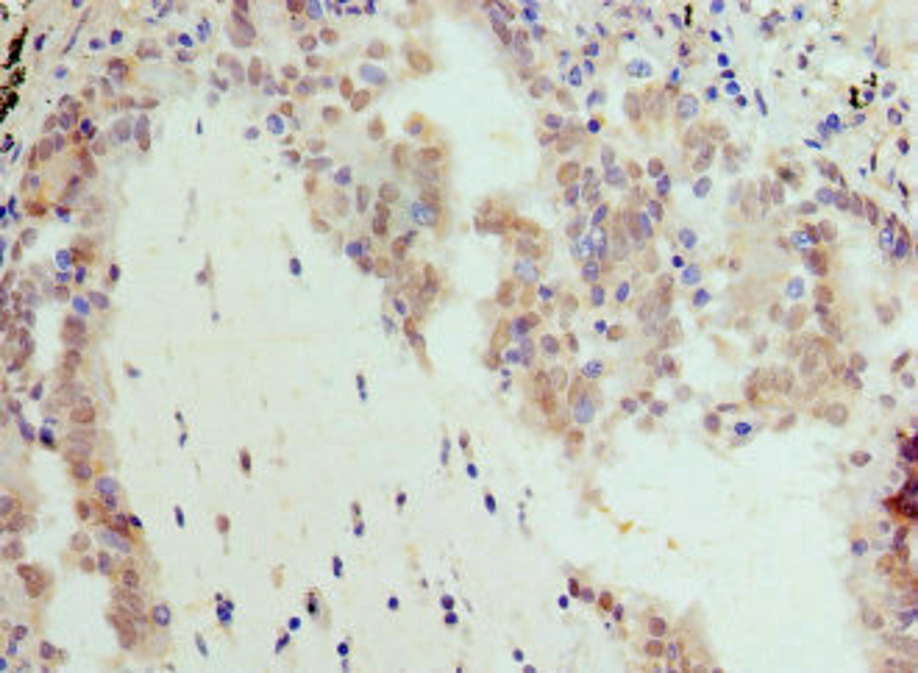Immunohistochemistry of paraffin-embedded human lung cancer using CSB-PA865097LA01HU at dilution of 1:100