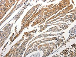 The image is immunohistochemistry of paraffin-embedded Human cervical cancer tissue using CSB-PA105672(STAT5B Antibody) at dilution 1/25. (Original magnification: ×200)
