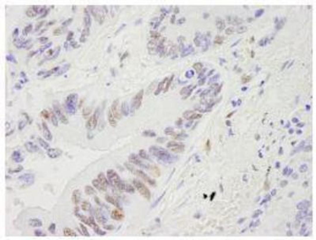 Immunohistochemistry-Paraffin: RECQ1 Antibody [NB100-619] - FFPE section of human lung adenocarcinoma.  Affinity purified rabbit anti-RecQ1 used at a dilution of 1:250. Detection: DAB  staining using Immunohistochemistry Accessory Kit