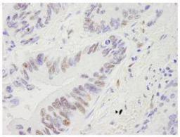 Immunohistochemistry-Paraffin: RECQ1 Antibody [NB100-619] - FFPE section of human lung adenocarcinoma.  Affinity purified rabbit anti-RecQ1 used at a dilution of 1:250. Detection: DAB  staining using Immunohistochemistry Accessory Kit