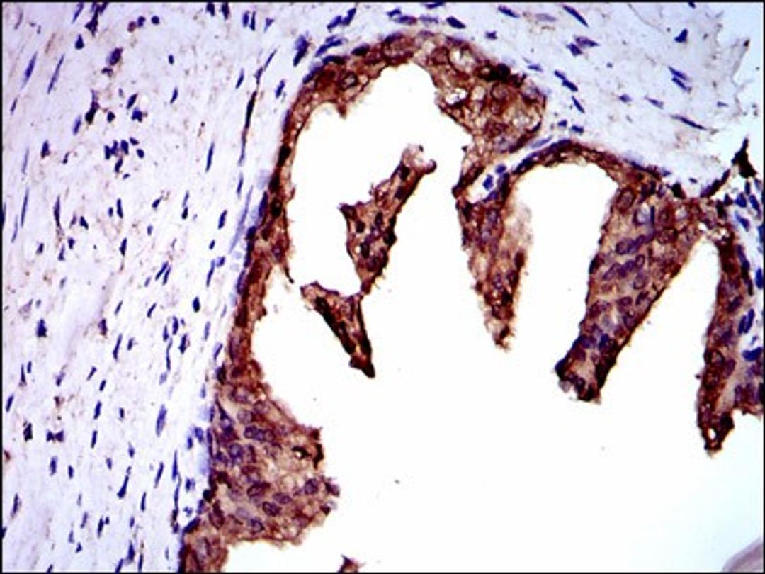 Immunohistochemistry: NEDD8 Antibody (5B8) [NBP2-37523] - Immunohistochemical analysis of paraffin-embedded prostate cancer tissues using NEDD8 mouse mAb with DAB staining.