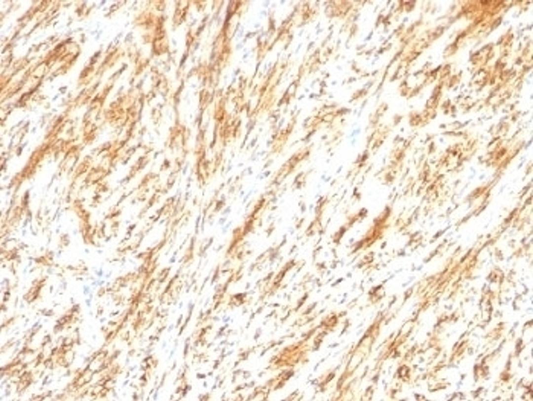 Formalin-fixed, paraffin-embedded human schwanoma stained with Glial Fibrillary Acidic Protein antibody (SPM248).