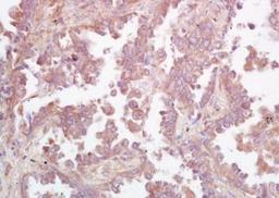 Immunohistochemical analysis of formalin-fixed paraffin embedded human lung carcinoma tissue using GCS antibody (dilution at 1:200)