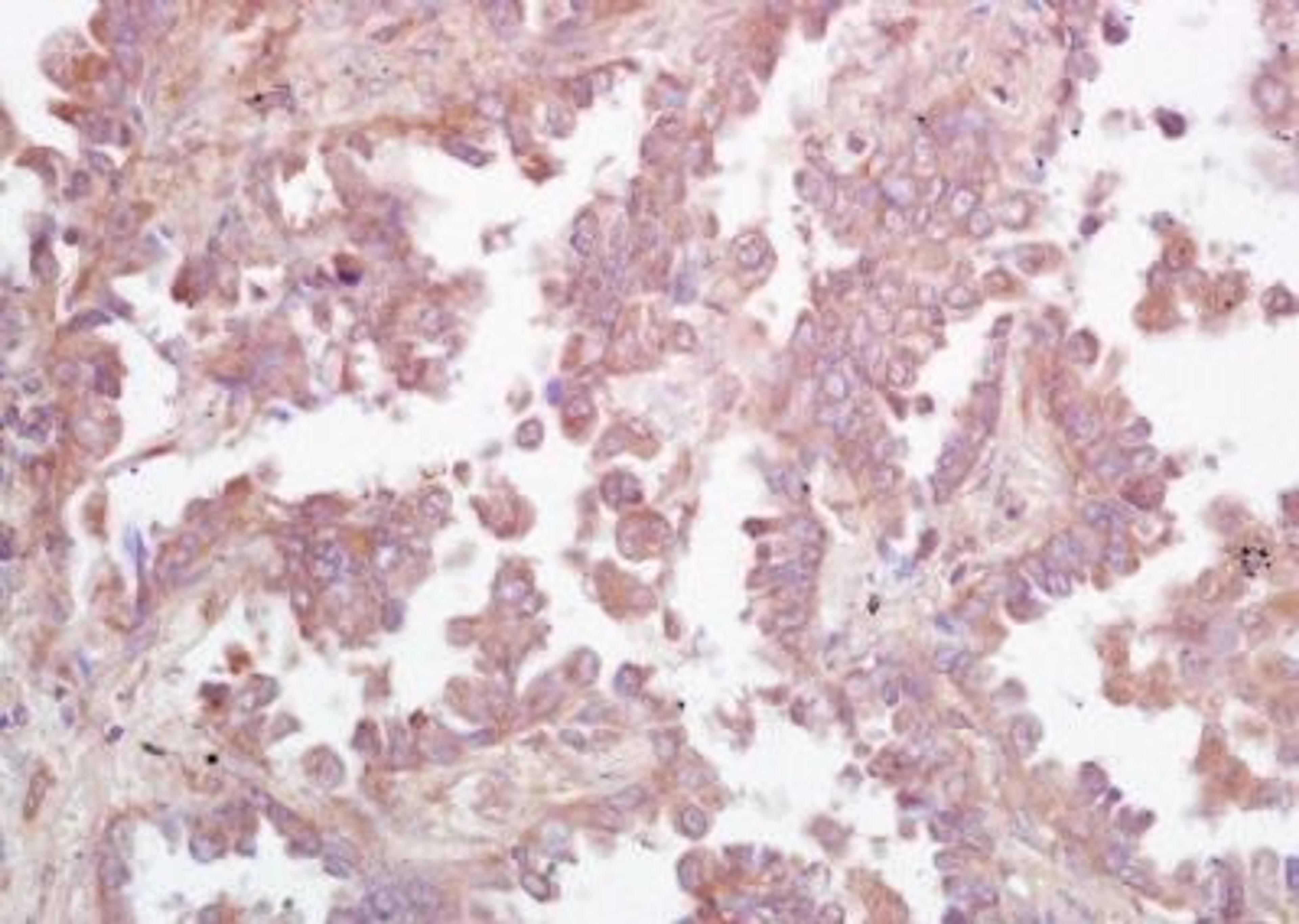 Immunohistochemical analysis of formalin-fixed paraffin embedded human lung carcinoma tissue using GCS antibody (dilution at 1:200)