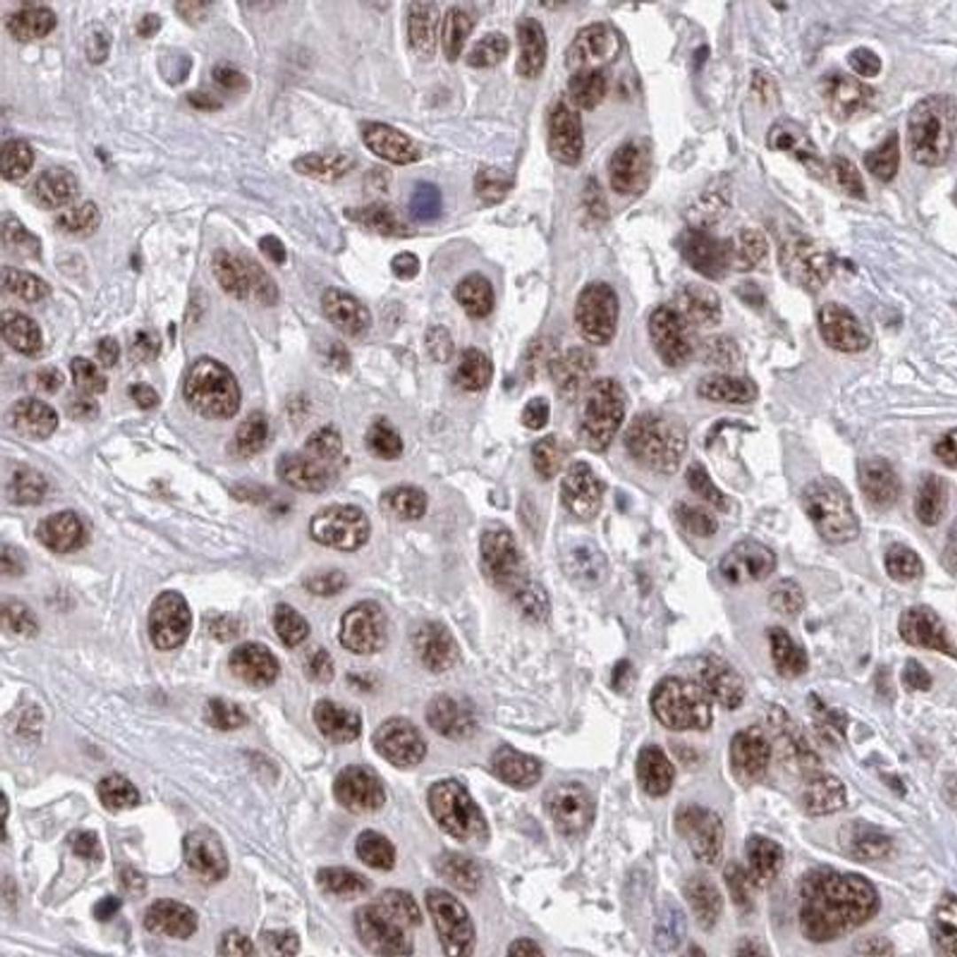 Immunohistochemistry: Nesprin-4 Antibody [NBP2-31811] - liver cancer