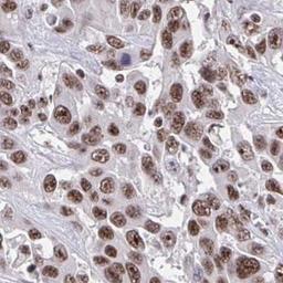 Immunohistochemistry: Nesprin-4 Antibody [NBP2-31811] - liver cancer