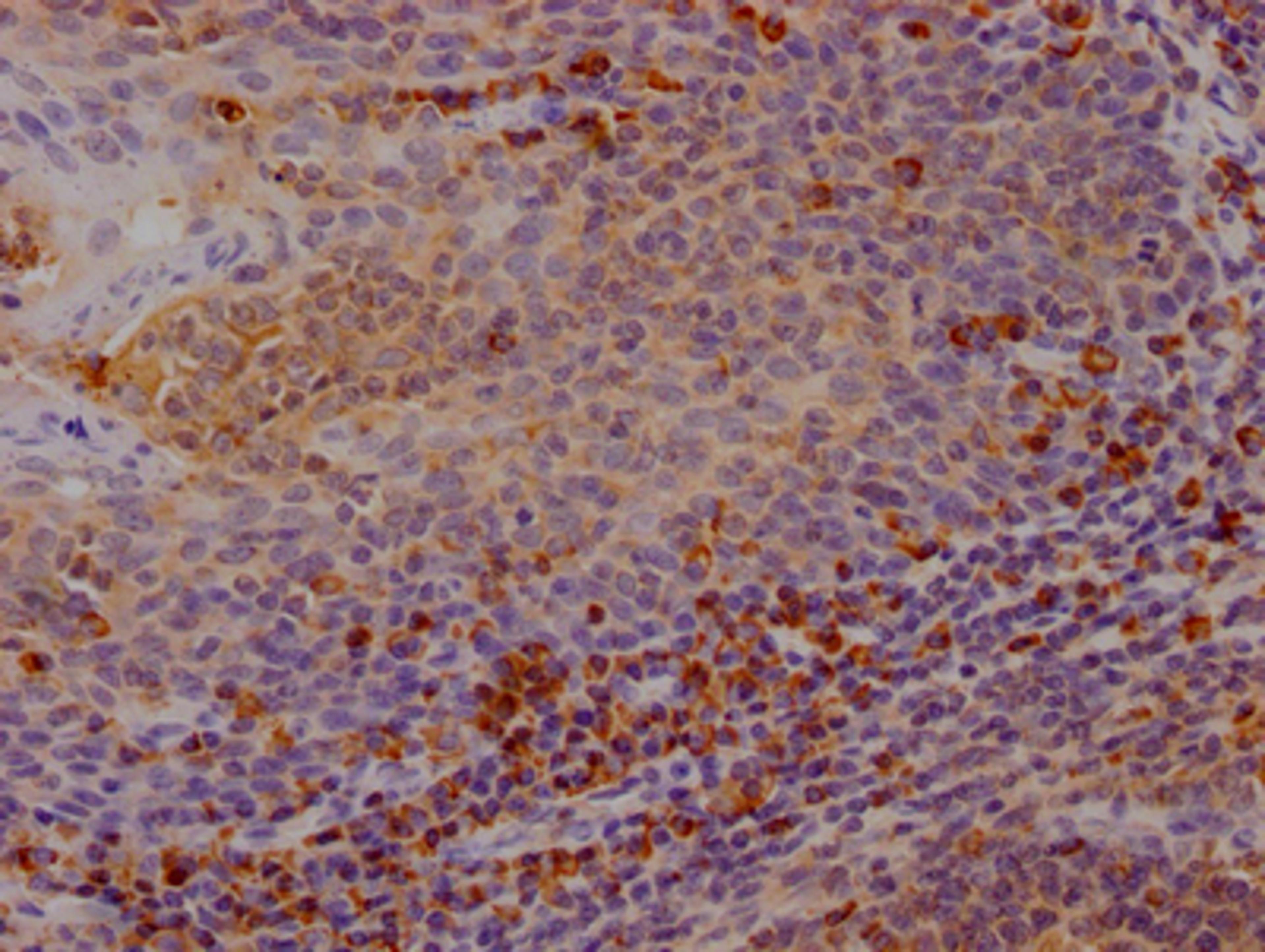 IHC image of CSB-RA213310A0HU diluted at 1:100 and staining in paraffin-embedded human tonsil tissue performed on a Leica BondTM system. After dewaxing and hydration, antigen retrieval was mediated by high pressure in a citrate buffer (pH 6.0). Section was blocked with 10% normal goat serum 30min at RT. Then primary antibody (1% BSA) was incubated at 4℃ overnight. The primary is detected by a Goat anti-rabbit IgG polymer labeled by HRP and visualized using 0.05% DAB.