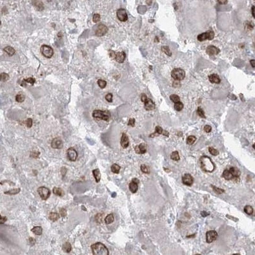 Immunohistochemistry: SORBS2 Antibody [NBP2-32672] - liver cancer