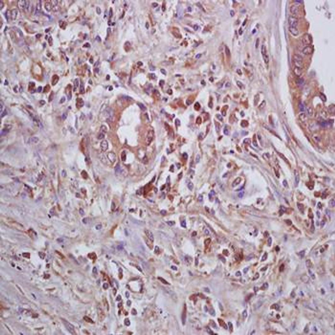 Immunohistochemical analysis of formalin-fixed and paraffin embedded human lung carcinoma tissue (dilution at:1:200) using Beta galactosidase antibody