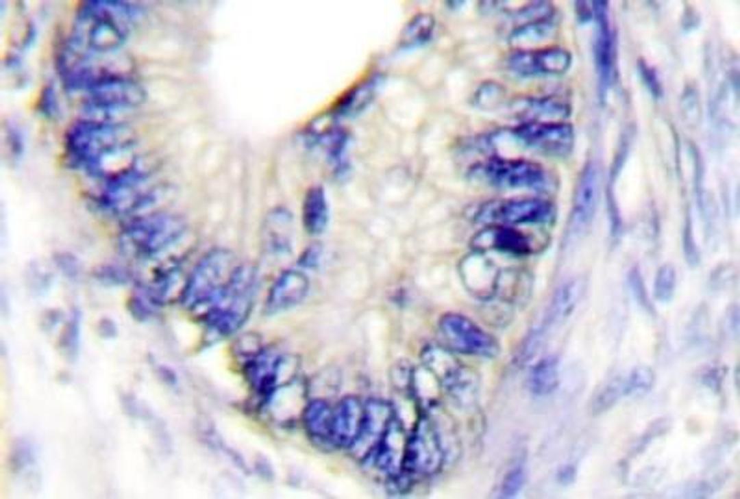 Immunohistochemistry-Paraffin: Claudin-3 Antibody [NB100-91711] - Paraffin-embedded human colon carcinoma tissue