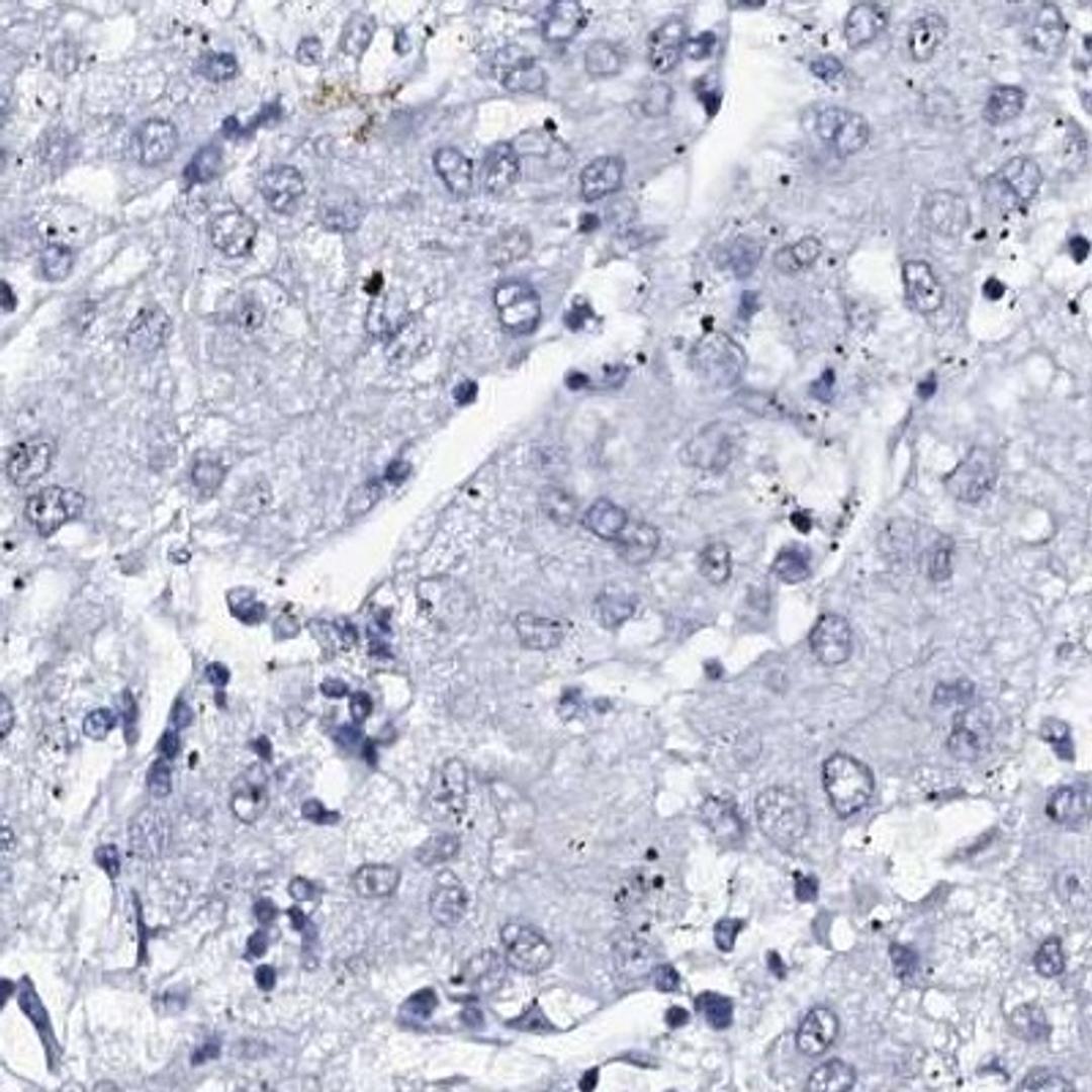 Immunohistochemistry: SPATA19 Antibody [NBP2-31979] - liver cancer