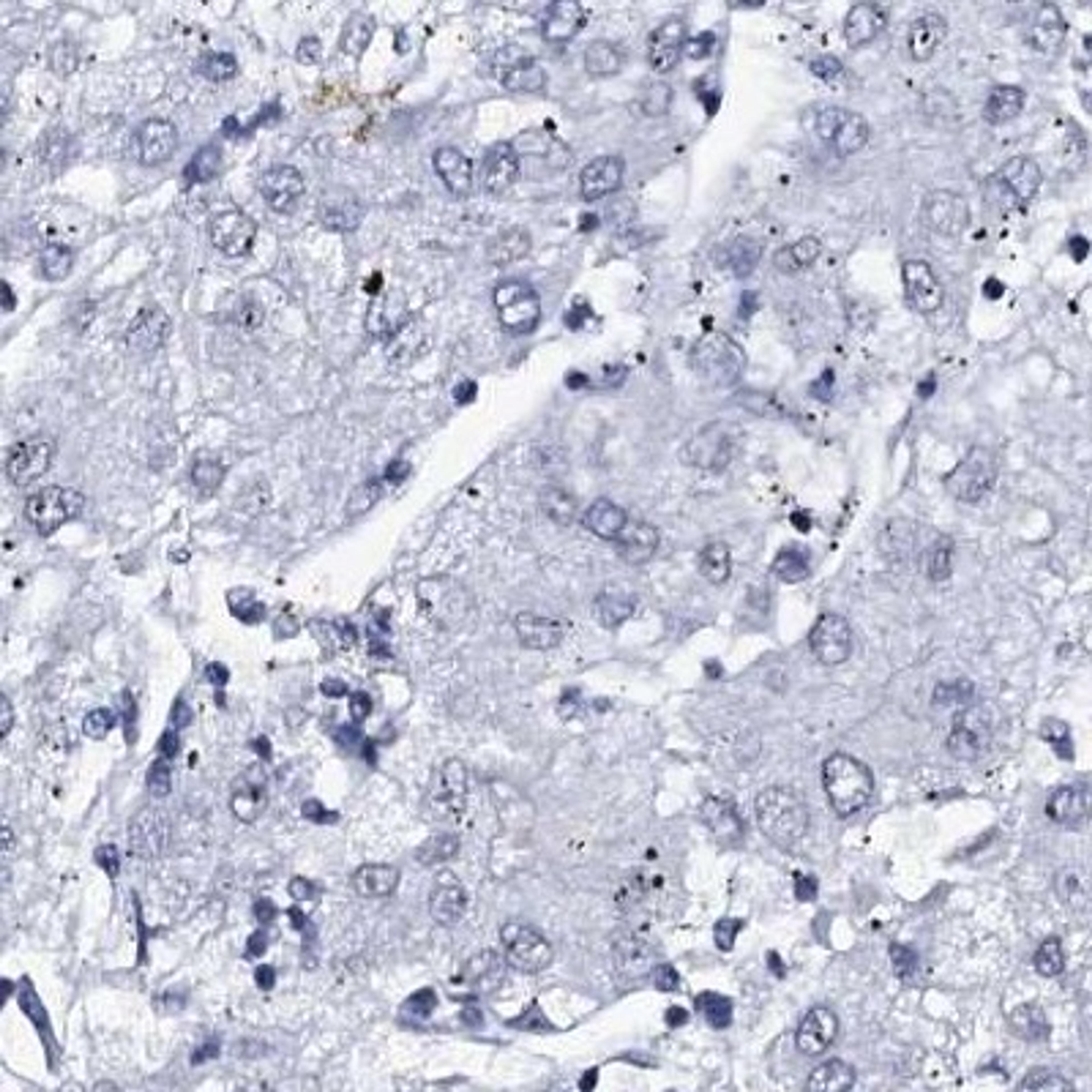 Immunohistochemistry: SPATA19 Antibody [NBP2-31979] - liver cancer