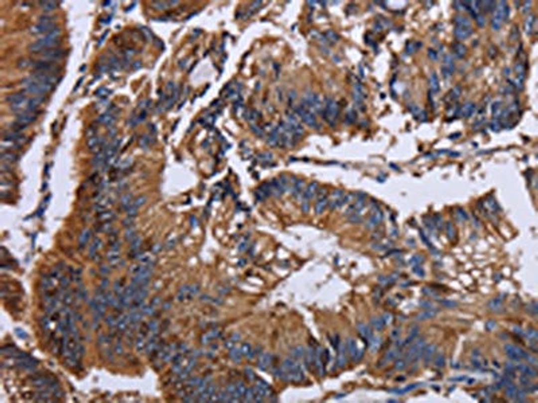 The image on the left is immunohistochemistry of paraffin-embedded Human colon cancer tissue using CSB-PA122155(KRT31 Antibody) at dilution 1/30, on the right is treated with fusion protein. (Original magnification: ×200)