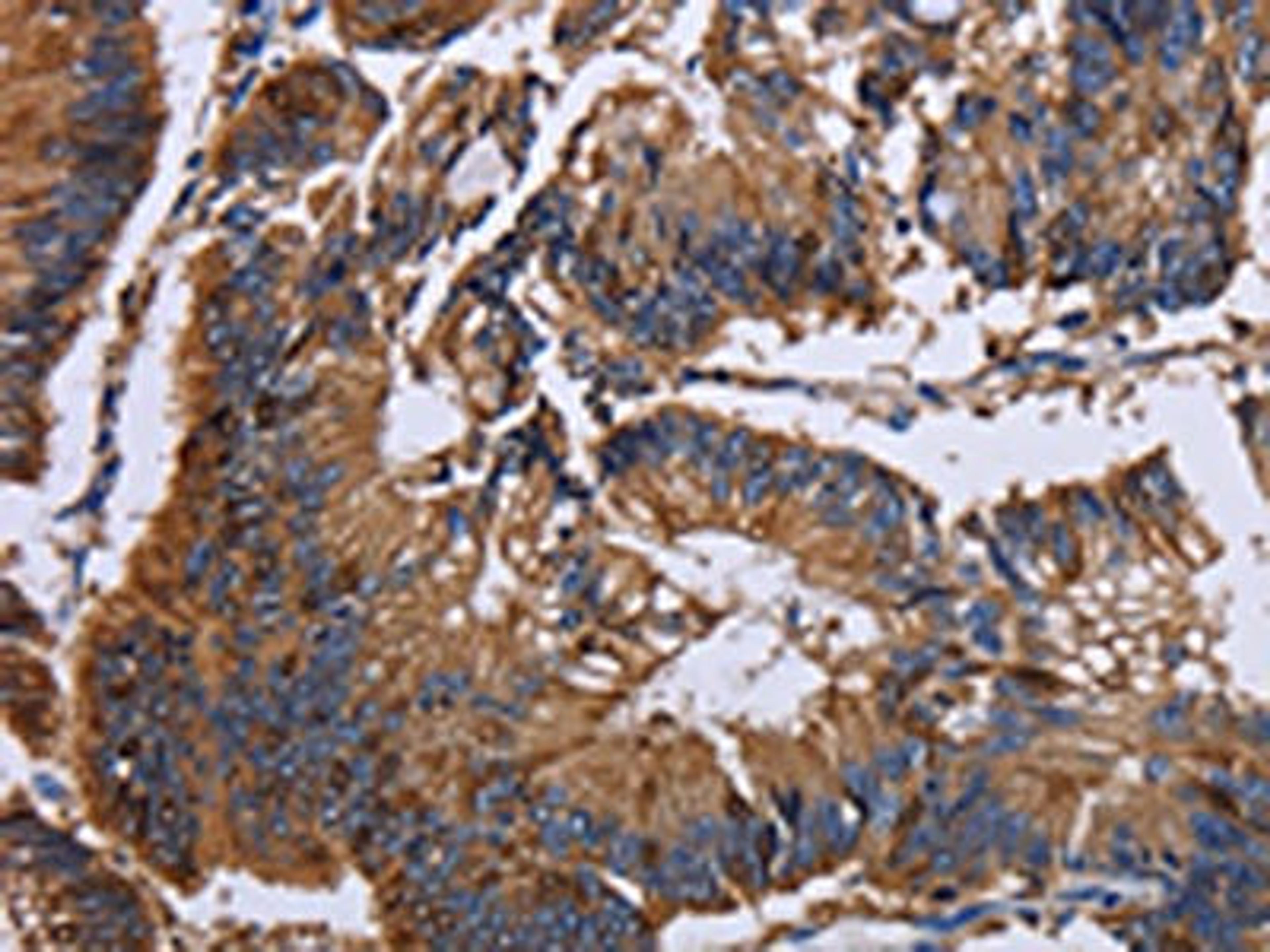 The image on the left is immunohistochemistry of paraffin-embedded Human colon cancer tissue using CSB-PA122155(KRT31 Antibody) at dilution 1/30, on the right is treated with fusion protein. (Original magnification: ×200)