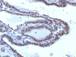 IHC testing of FFPE human thyroid carcinoma with TSHR antibody (clone SPM223). Required HIER: boil tissue sections in 10mM Tris with 1mM EDTA, pH 9, or 10mM citrate buffer, pH 6, for 10-20 min followed by cooling at RT for 20 min.