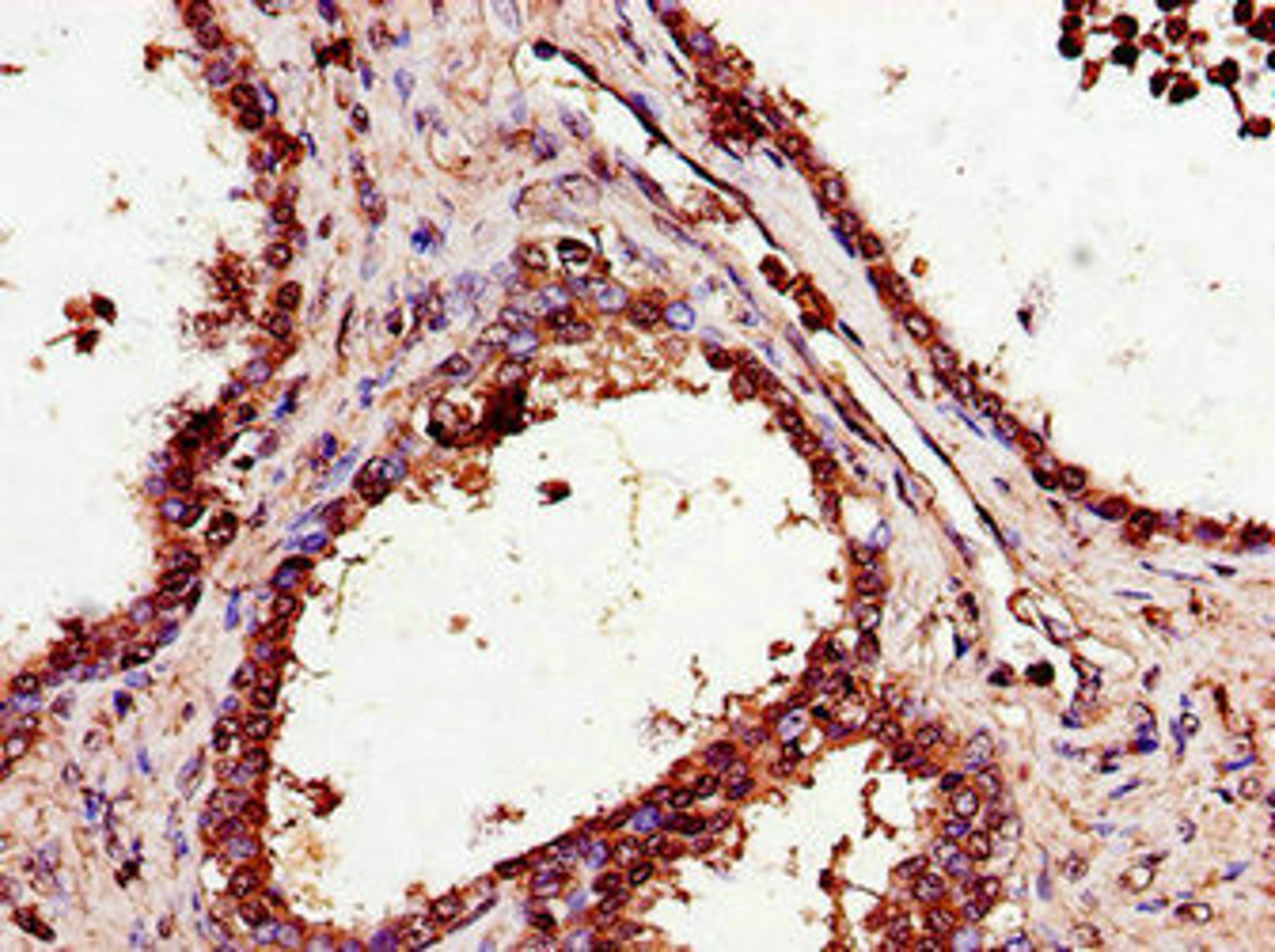 Immunohistochemistry of paraffin-embedded human prostate cancer using CSB-PA021854LA01HU at dilution of 1:100