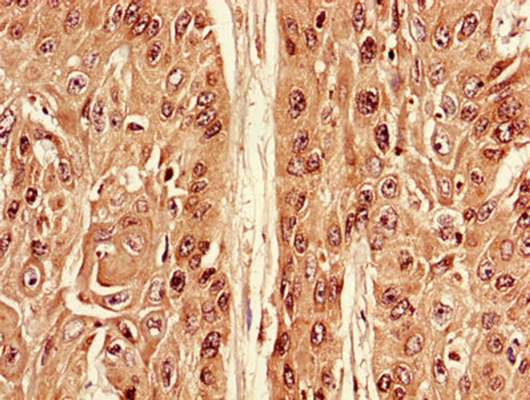 Immunohistochemistry of paraffin-embedded human cervical cancer using CSB-PA002294LA01HU at dilution of 1:100