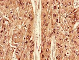 Immunohistochemistry of paraffin-embedded human cervical cancer using CSB-PA002294LA01HU at dilution of 1:100