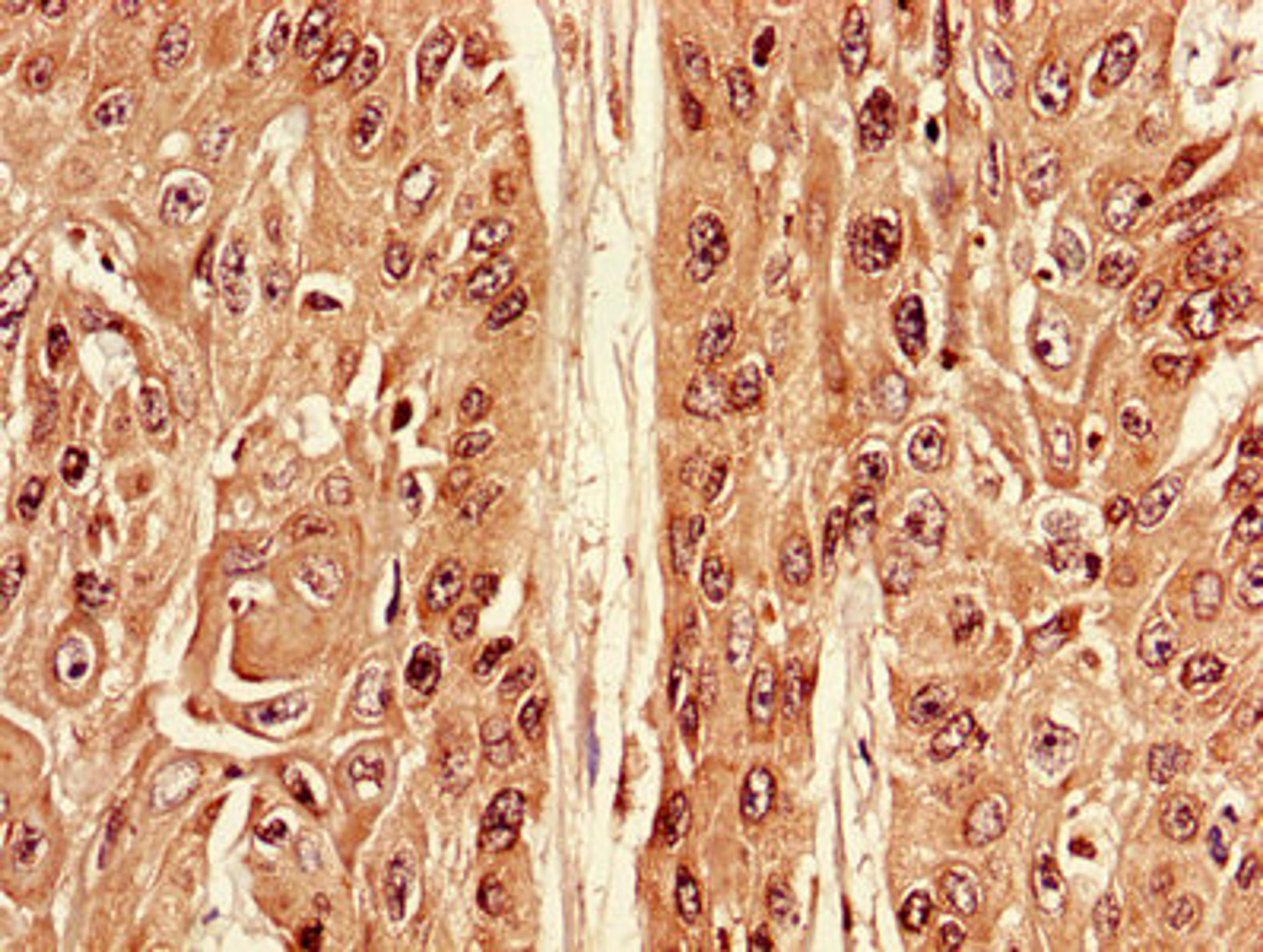 Immunohistochemistry of paraffin-embedded human cervical cancer using CSB-PA002294LA01HU at dilution of 1:100